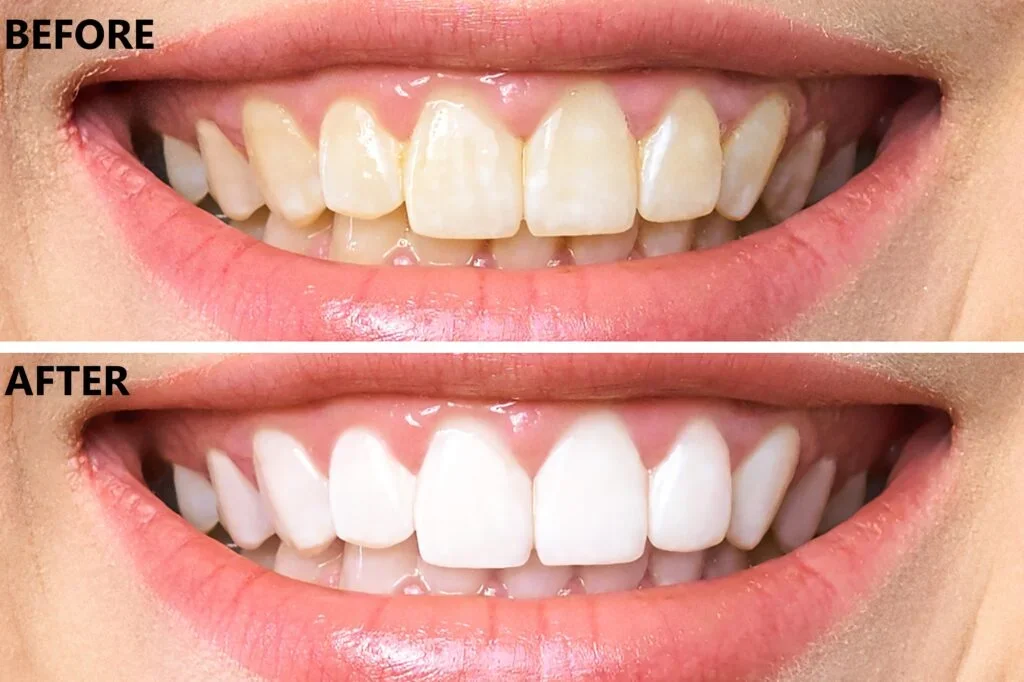 Professional Teeth Whitening
