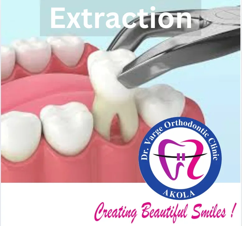 Tooth Extractions